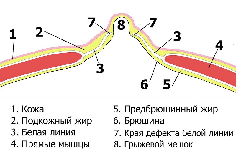 тренировка пресса при диастазе