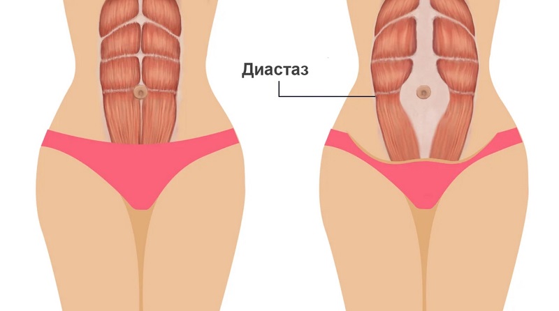 тренировка пресса при диастазе