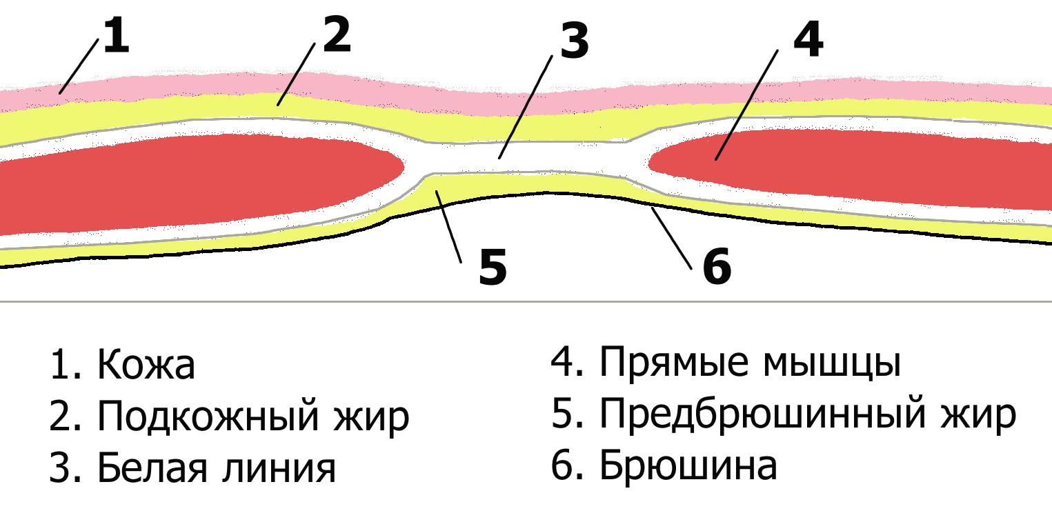 Диастаз прямых мышц фото