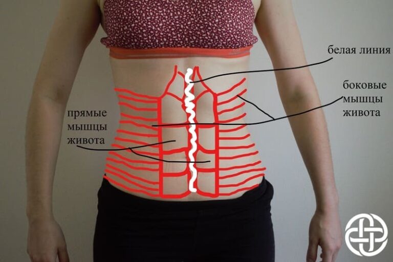 Диастаз живота фото у мужчин