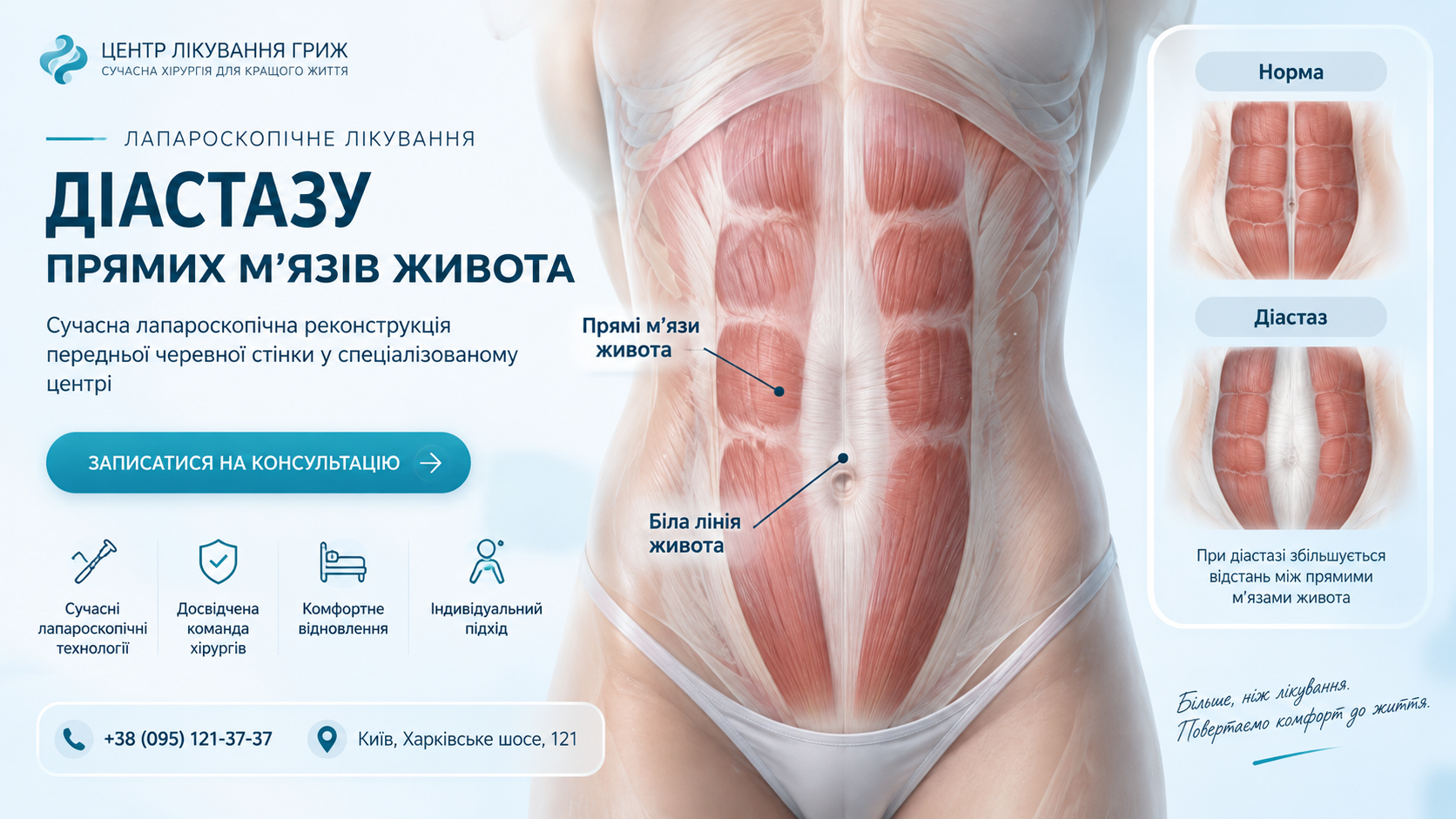 Схема: розходження прямих м’язів по білій лінії живота